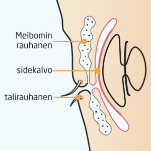 Silmäluomien rauhaset kuten Meibomin rauhaset voivat tukkeutua.